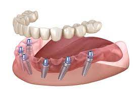 Will Implant Supported Dentures Feel Like Natural Teeth? - Prince William  Dental Gainesville Virginia